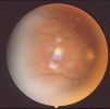Candidiasis macular 20-1