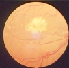 Circinata macular 21-1