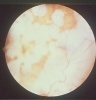 Corioretinosisi Miopica M2
