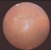 Rotura retina 20-1